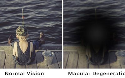 Keeping Sight of Age-Related Macular Degeneration